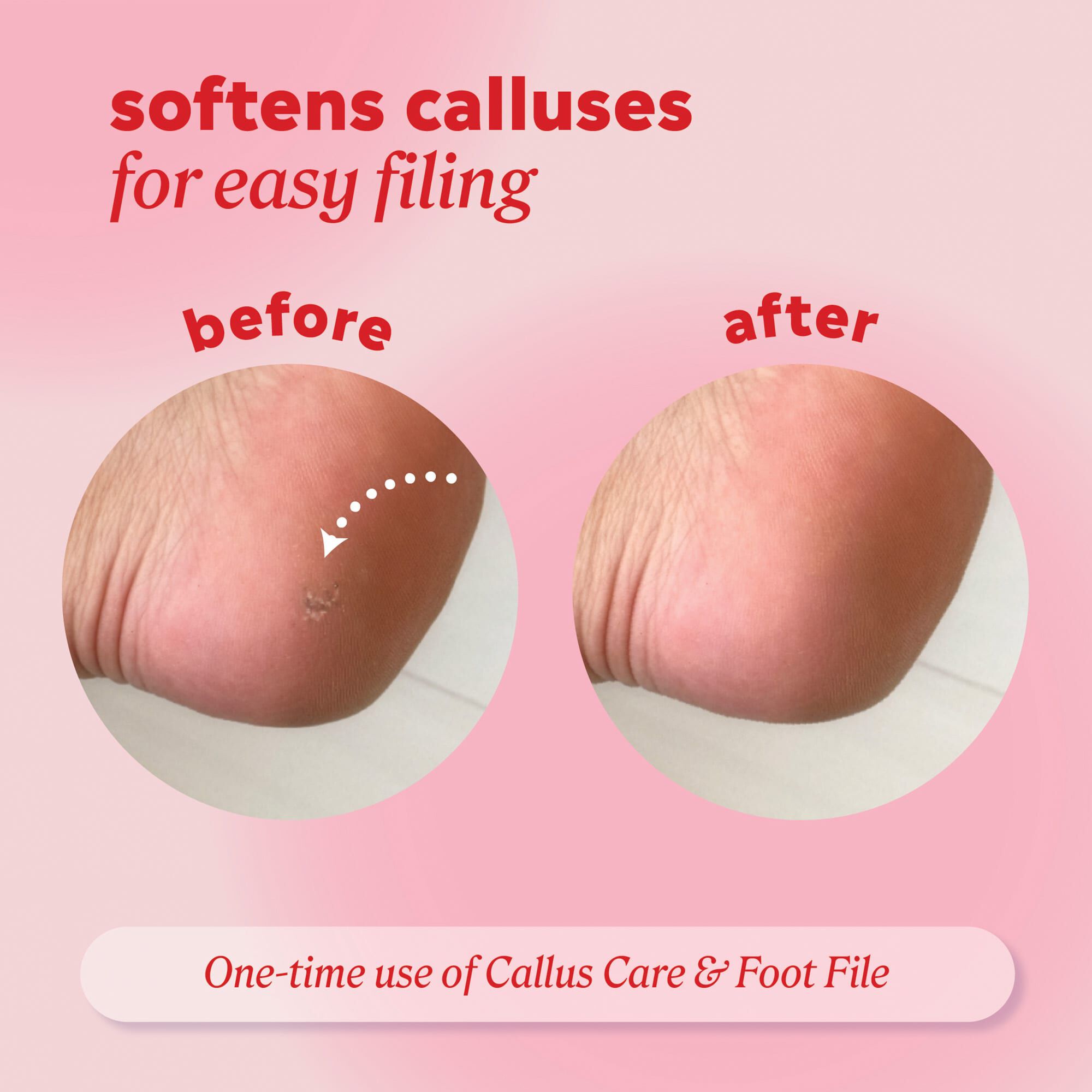 ONYX Professional Callus Care Callus & Corn Peeling Gel, , large