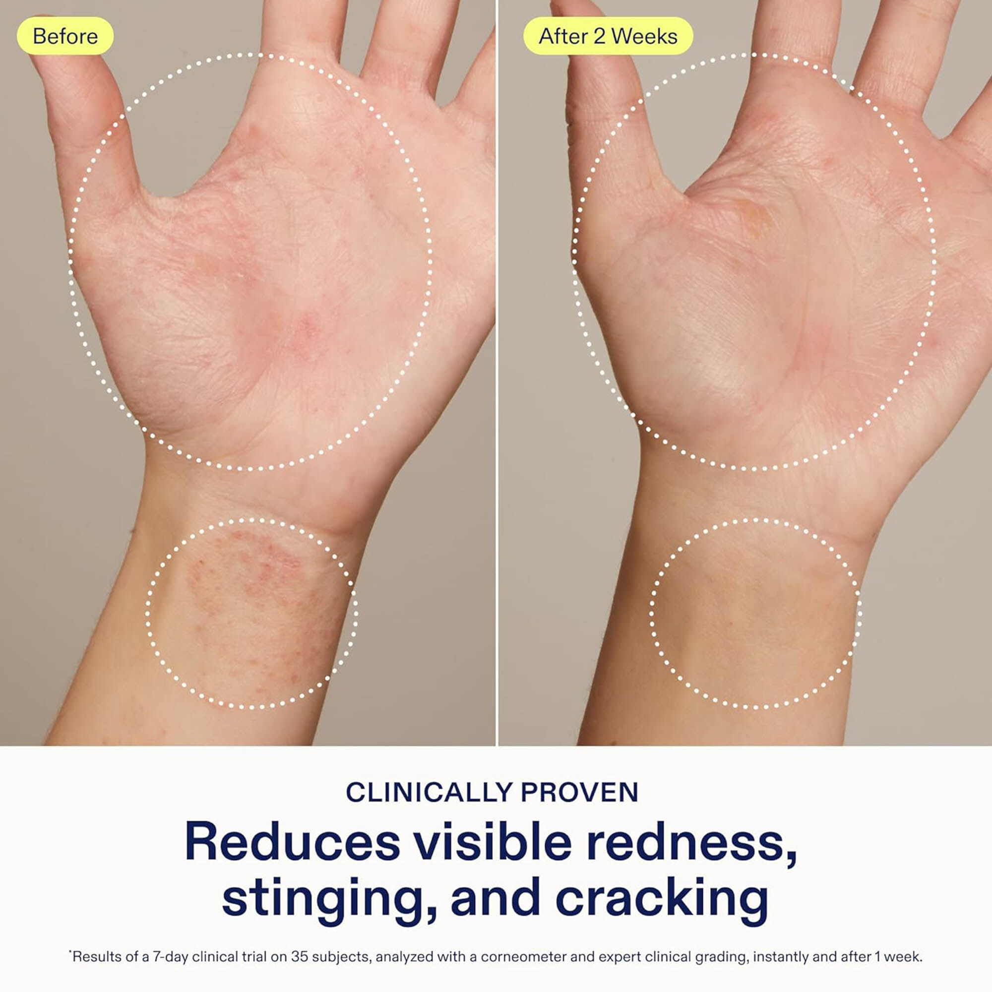 Skinfix Hand Relief Cream, 3 fl. oz., , large